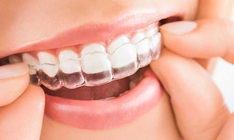 How To Look After Your Aligners