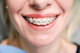 Straightening Smiles: Decoding the Pros and Cons of Dental Braces